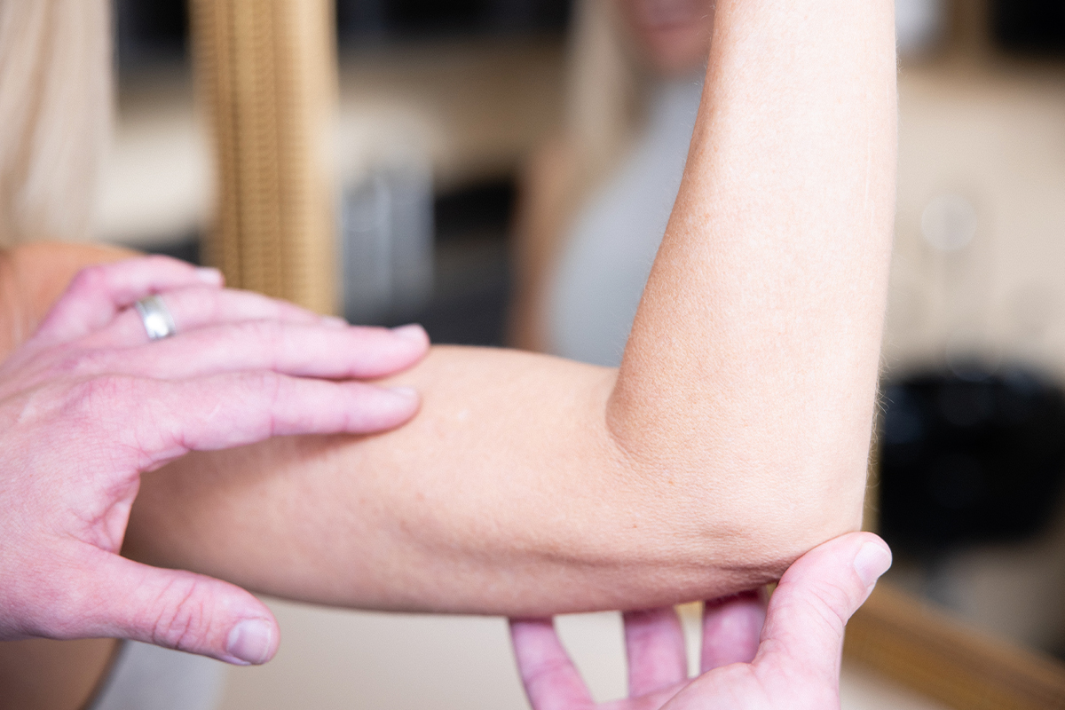 flexed arm after an arm lift in Gulf Shores