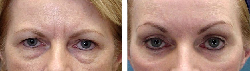 patient results of blepharoplasty in Gulf Shores, AL