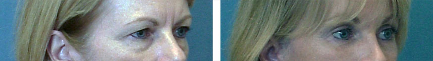 patient results of blepharoplasty in Gulf Shores, AL